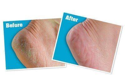 Foot Callus Remover - MomyMall