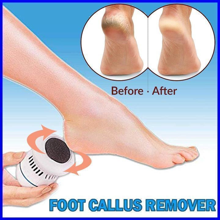 Foot Callus Remover - MomyMall